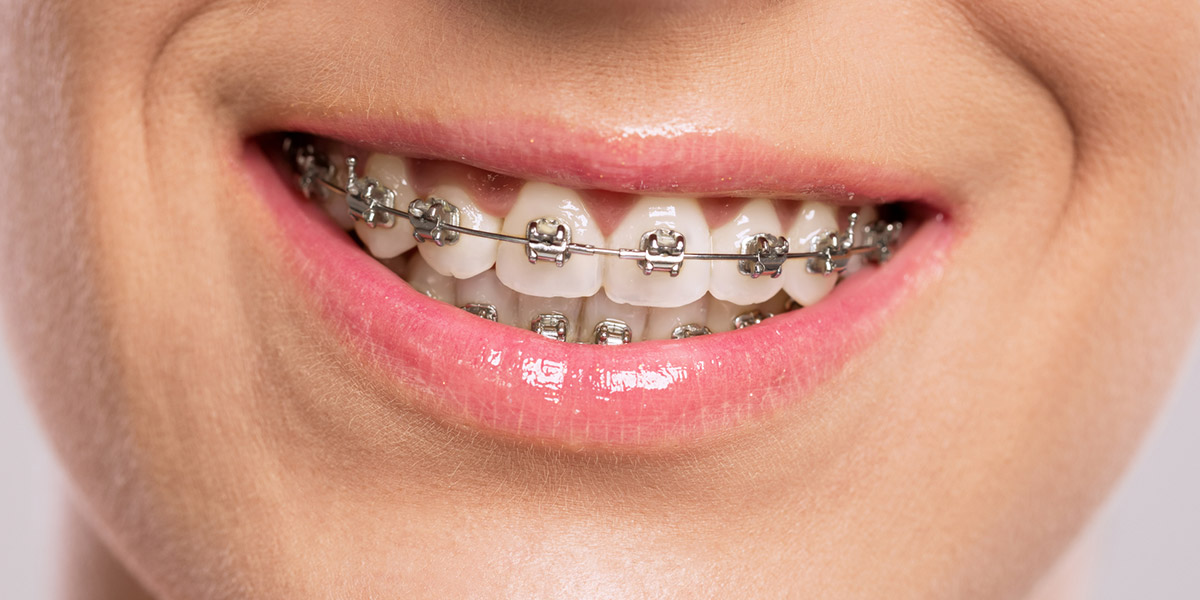 brackets on teeth